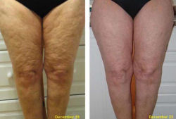 Cellulite Demo. Click for larger image